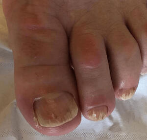 Is It A Fungal Nail?